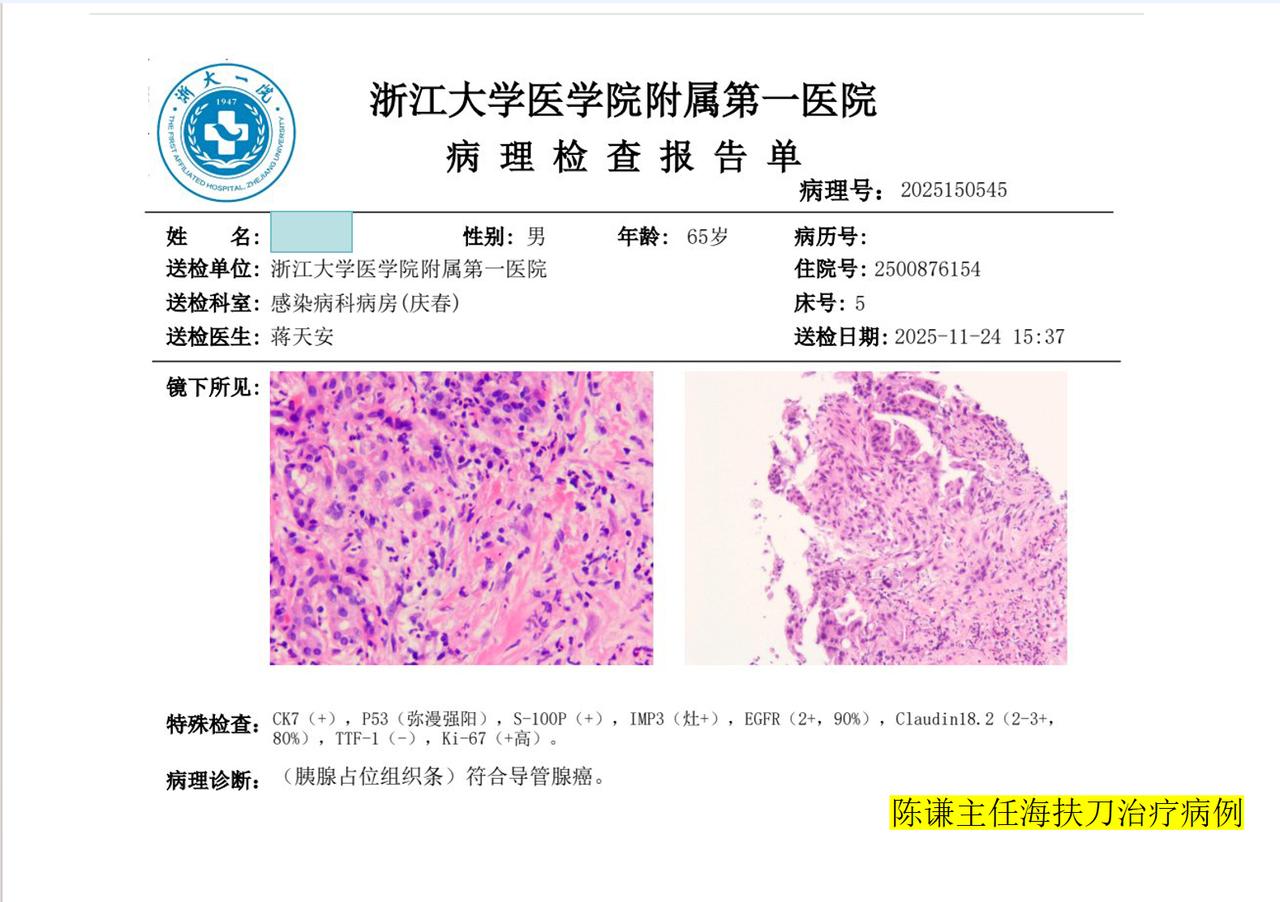 这是我们12月底治疗的一个晚期胰腺癌患者，病人发现胰腺不到一个月，由于肿瘤已经侵