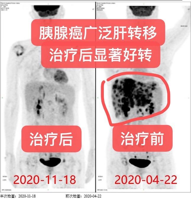 胰腺癌多发肝转移的治疗。晚期胰腺癌广泛性肝转移，无法治愈，只能延长生存...