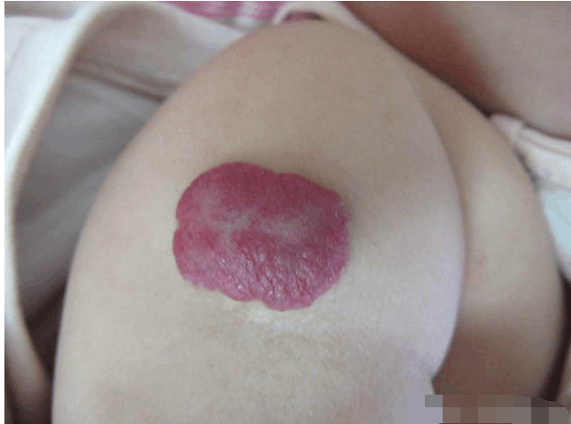 宝宝的红胎记不能视若无睹, 这些误区可能会延误宝宝病情