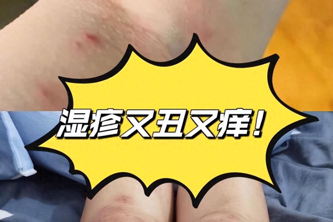 8张湿疹“王牌方”：风、热、水湿三邪全排，多数湿疹可从根调理提示：本内容仅