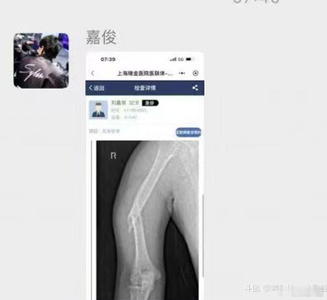 枫哥说Sylar骨折还蛮严重的，喝酒那天晚上都喝多了，不知道Sylar到底是怎么