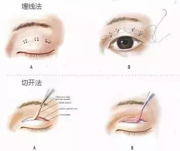 双眼皮术后丨医生为什么让你多练习睁闭眼呢?