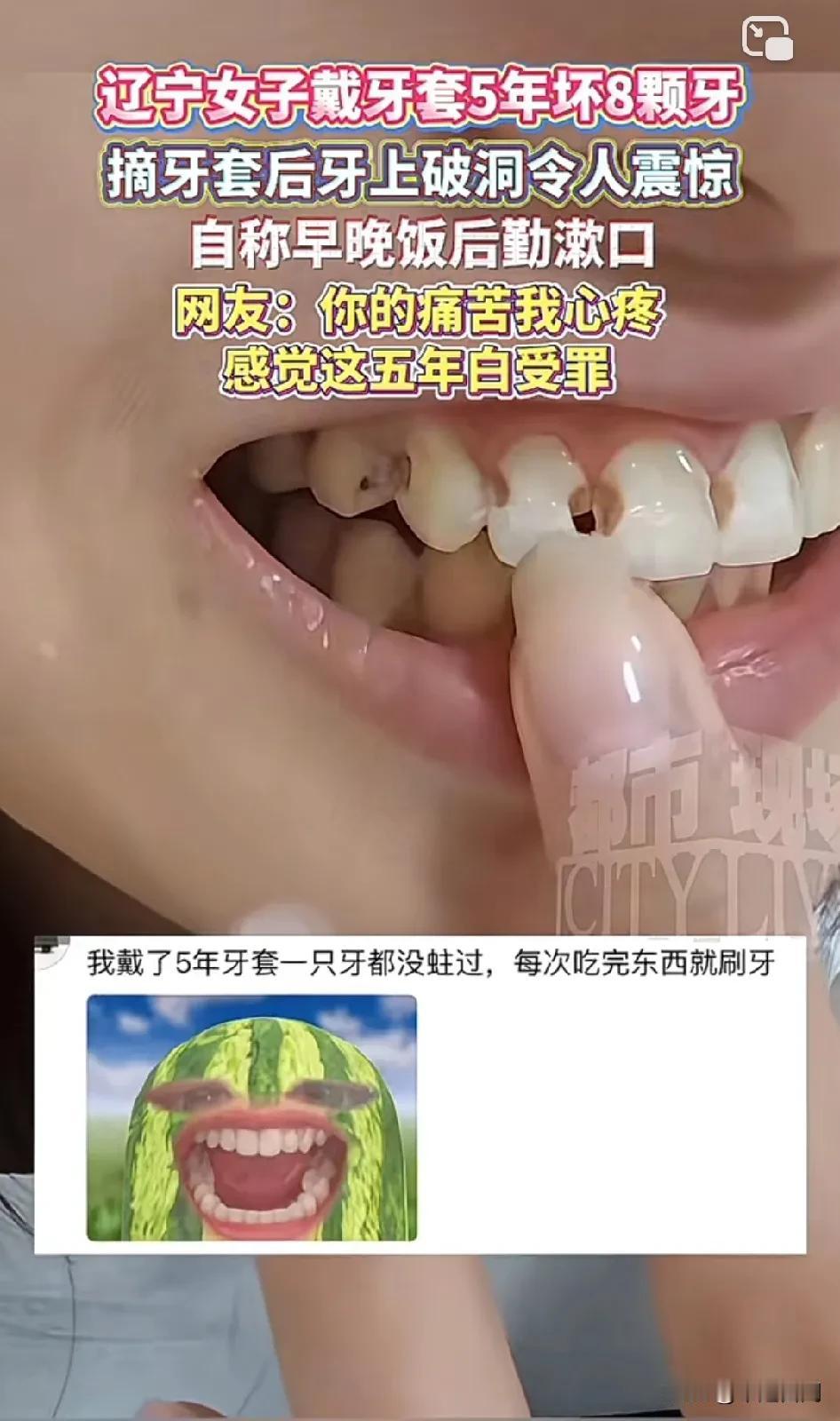 万万没想到，本来为了美观，结果害了自己！辽宁女子戴牙套5年坏8颗牙，摘牙套后牙