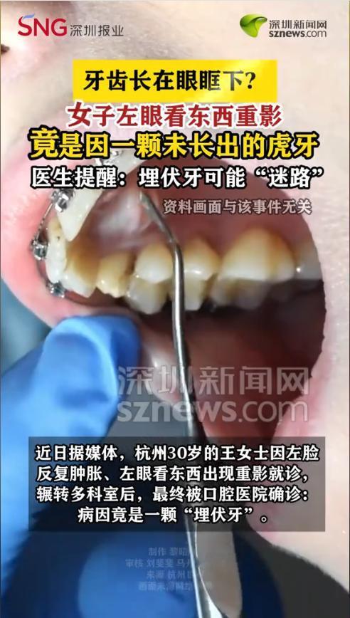 虎牙‘迷路’生长，女子左脸反复肿胀、视物重影！医生紧急提醒：埋伏牙不处理，小心颌骨病变！