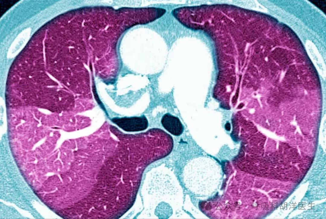 MDA5抗体阳性相关间质性肺病，是一种进展极快、死亡率极高的凶险疾病，绝非“