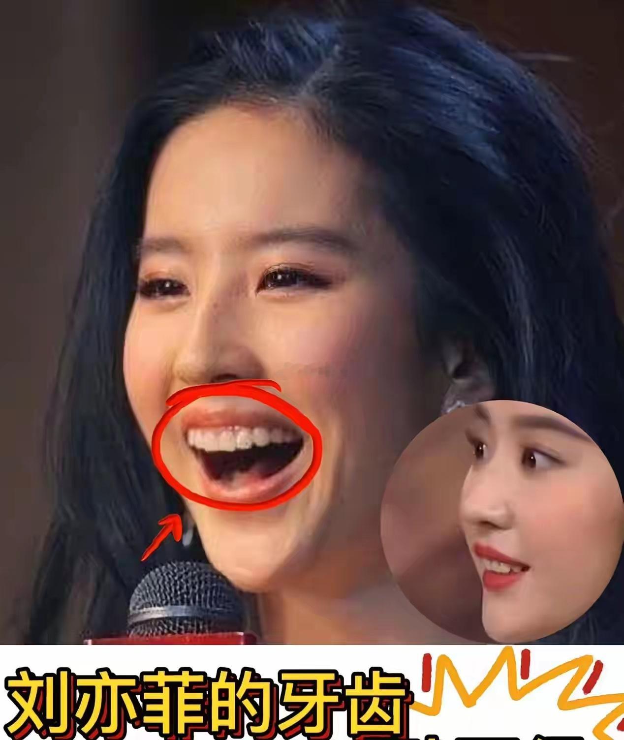 刘亦菲的牙齿怎么怪怪的，是深覆合吗
