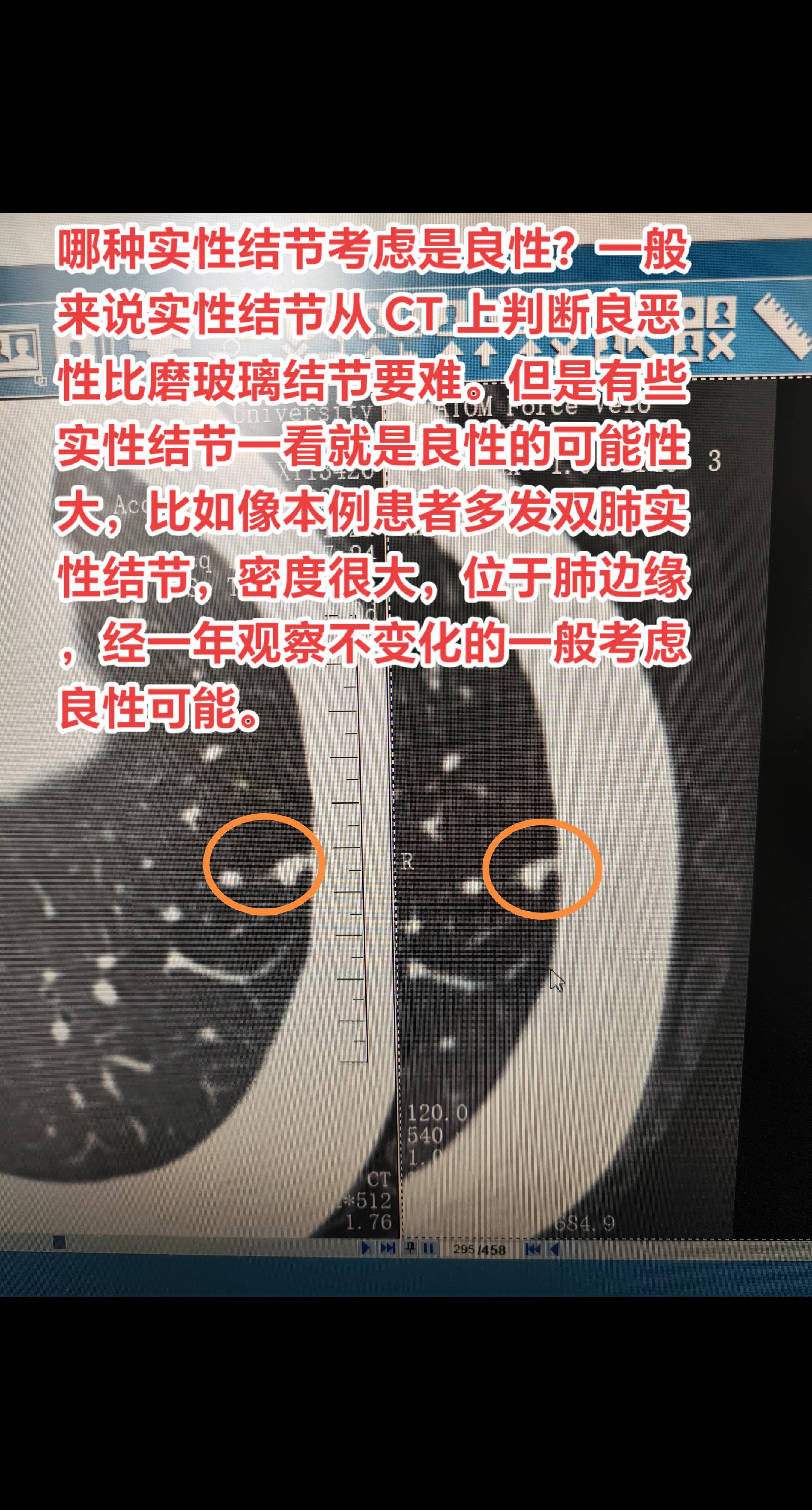有这些特点的实性肺结节考虑良性。一般来说实性结节从 CT 上判断良恶性...