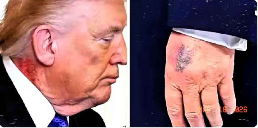 特朗普的身体状况，怕是真的瞒不住了最近流出的照片里，他脖子和手背的红色斑