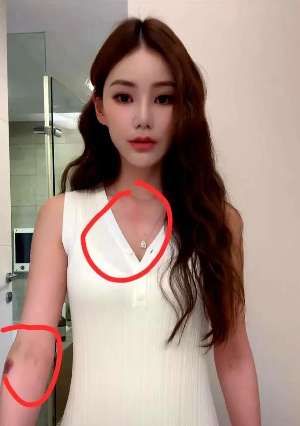 马筱梅这次亮相让大家心疼大家都看到了，她的手上淤青，虽说她自己解释了说现在法