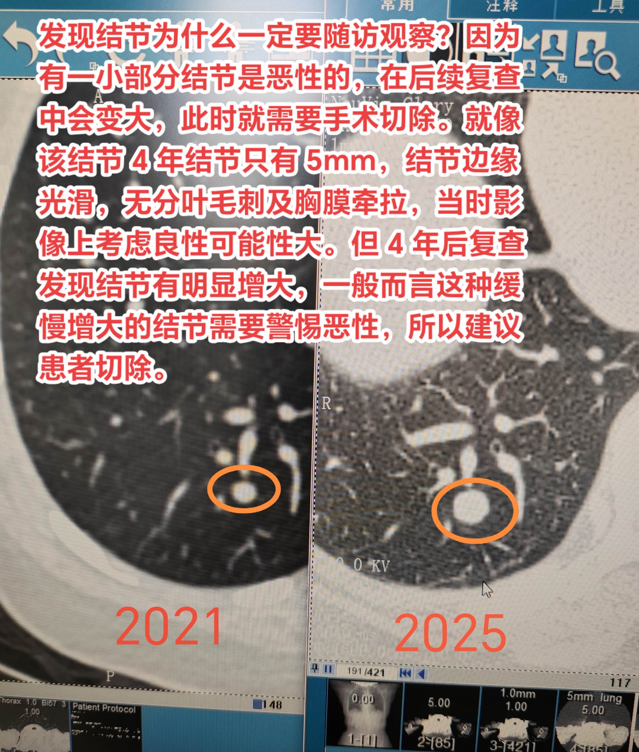 发现结节为什么一定要随访观察？因为有一小部分结节是恶性的，在后续复查中...