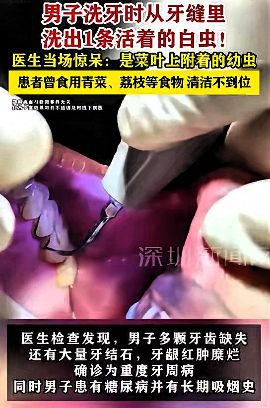 福建泉州，一男子不太注意口腔卫生，他假牙戴着很不舒服，所以想着去医院换一副，医生
