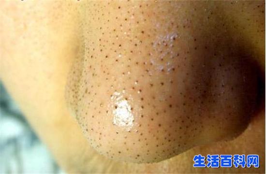 鼻子上的黑头是怎么形成的? 该如何根除