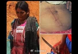 墨西哥一名孕妇用菜刀为自己实施剖腹产手术，产下一名健康的男婴。这被认为是第一例自