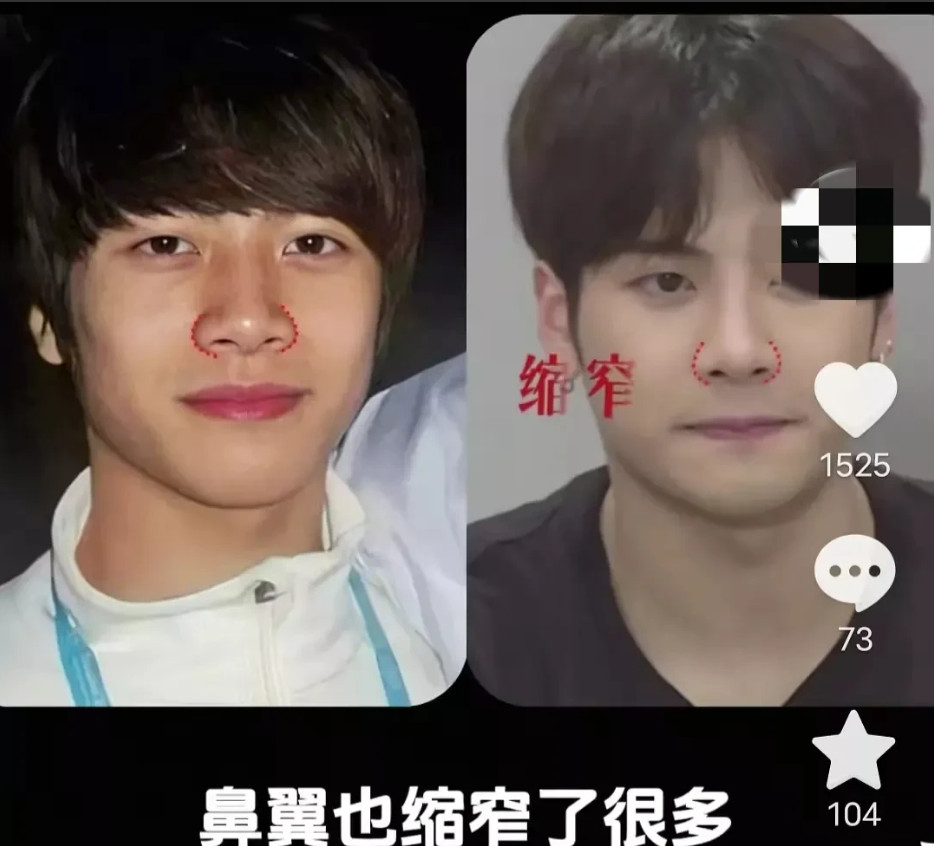 原以为王嘉尔是原生脸，没想到也有医美微调痕迹。近日有整容机构账号称他需修复，对比