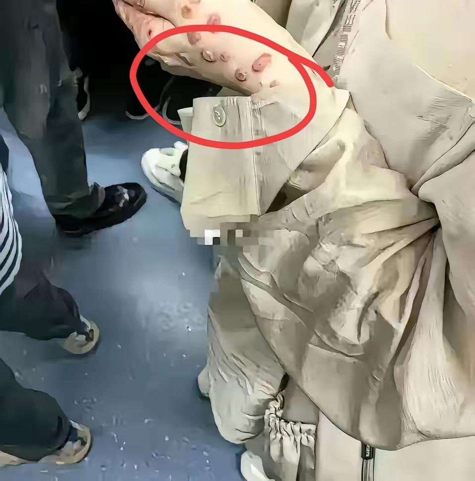 地铁上见到一个漂亮姑娘，长的确实很漂亮！但是突然看到她手上那么多红疹。大伙儿知