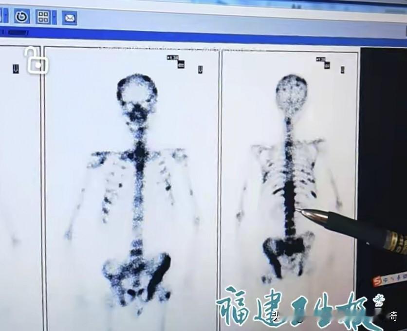 年年体检还查出全身20多处肿瘤？福建这位大爷的遭遇真给所有人敲了警钟！