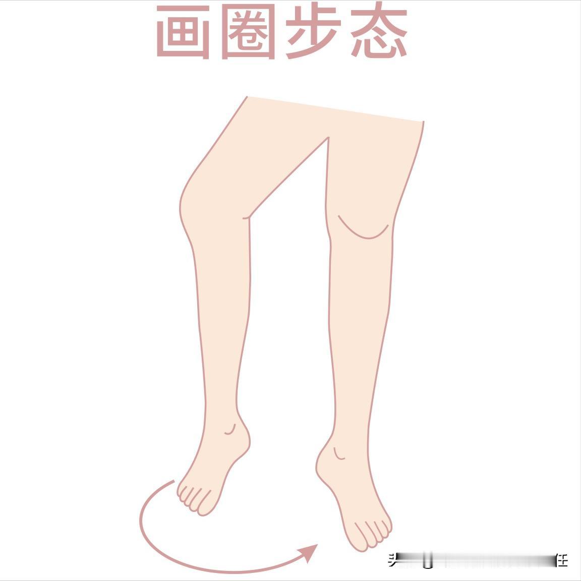 偏瘫告别划圈腿的几个方法，你做到了吗！ 偏瘫之后，很多人会出现步态异常的情况