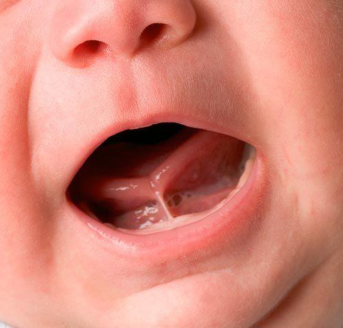 舌系带过短的婴儿如何实现母乳喂养?
