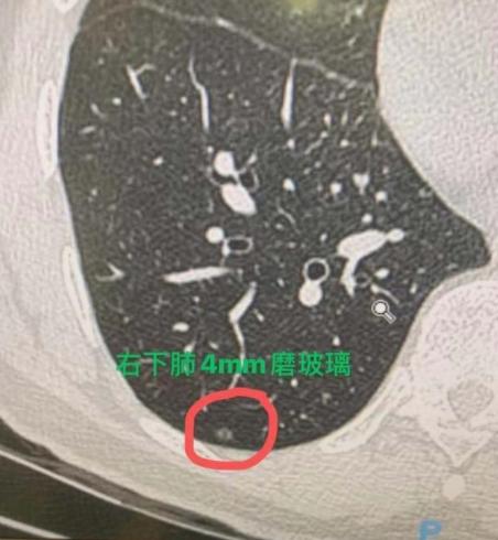 5mm以下肺微小结节，不必过度焦虑！不少人体检做完胸部CT，查出2-4mm的肺