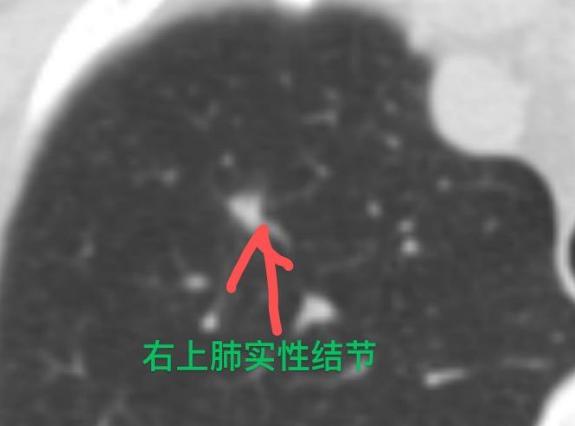 今天做这台肺结节手术，说实话我心里也一直悬着！患者四十多岁，去年就查出来右上肺有