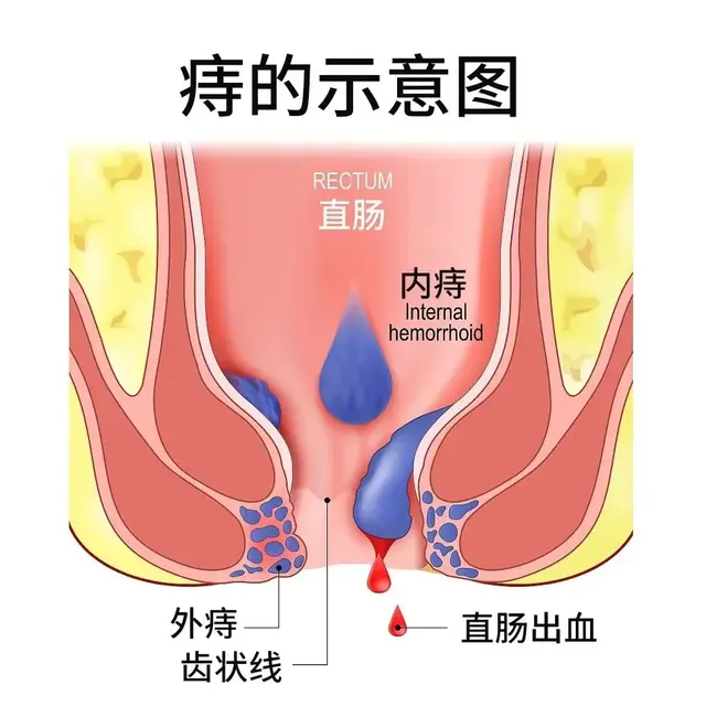 怎么判断自己得了痔疮