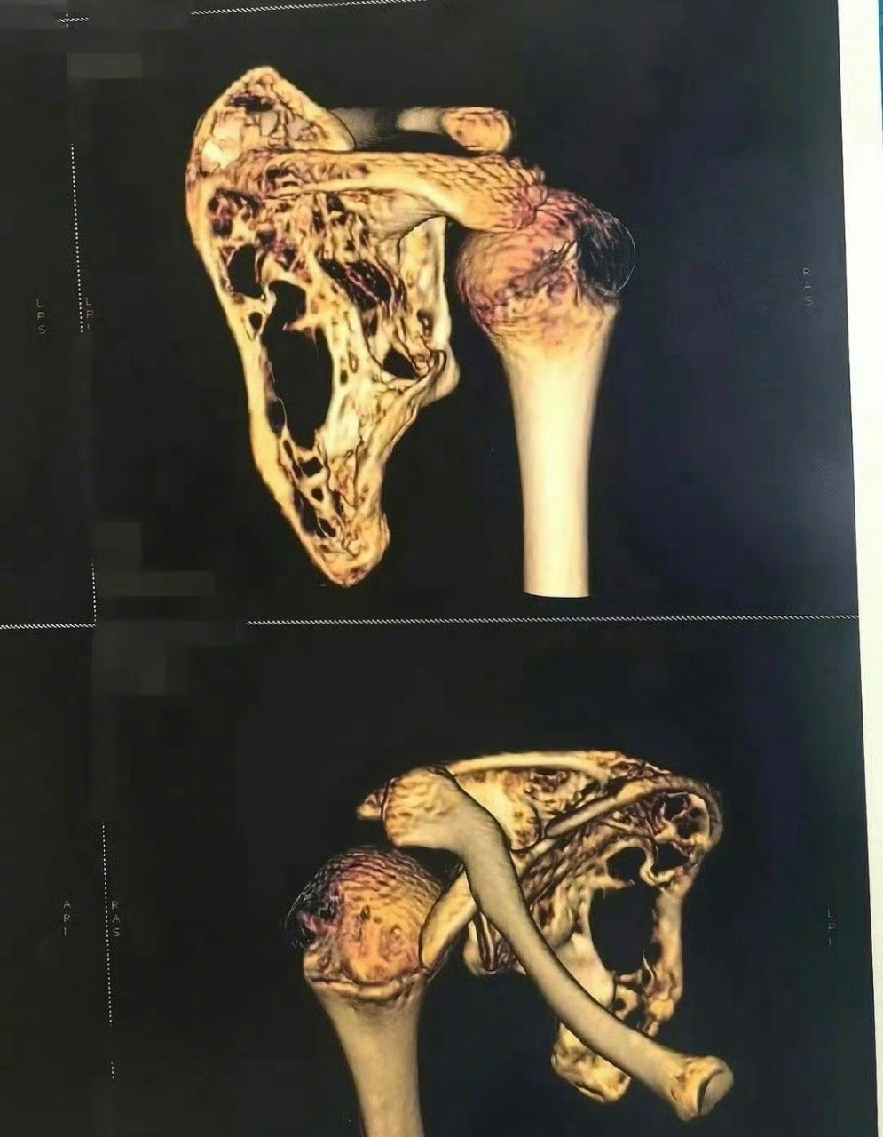 #11年4次手术失败女孩再迎希望手术#河北邯郸女孩小彤，11年前摔伤骨折后骨骼