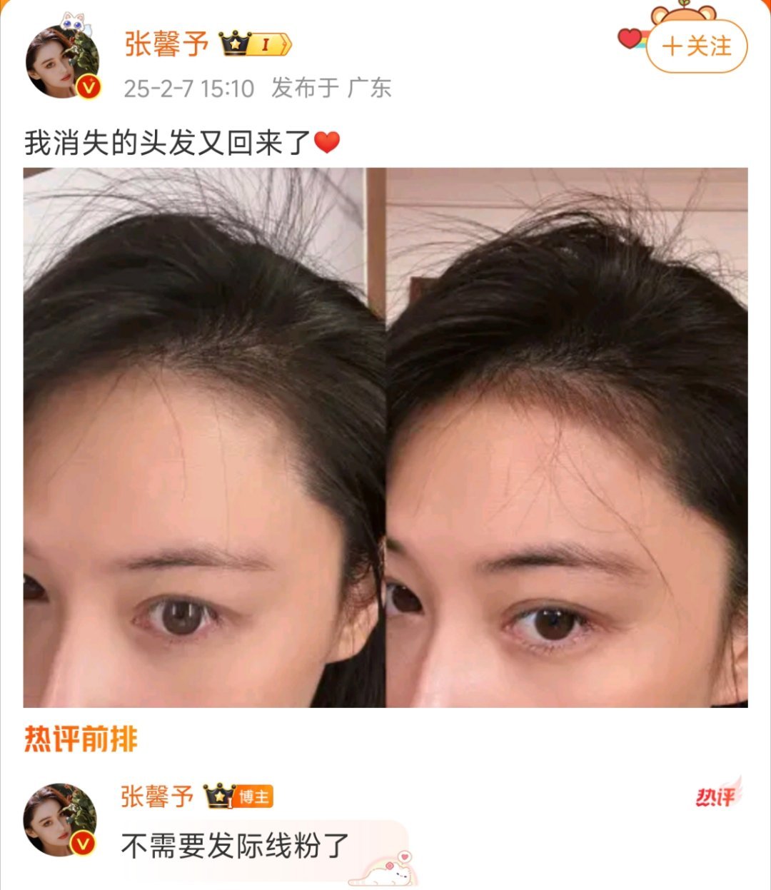 张馨予发际线怎么养的，求教程