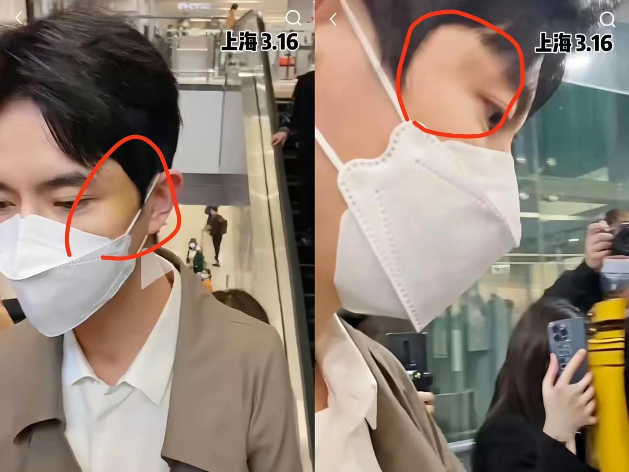 以下是一篇相关的今日头条爆款文章：男星脸上淤青反复出现？早有迹象引猜测