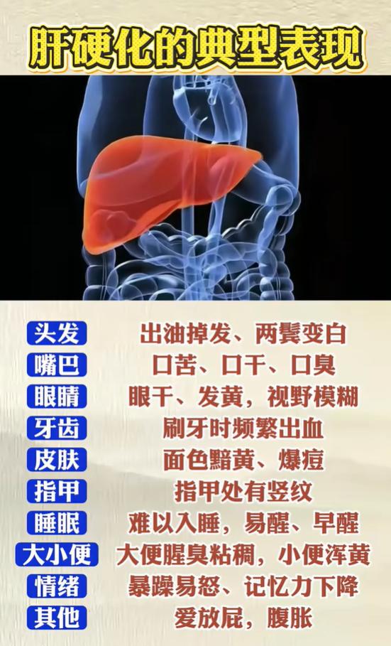 肝硬化属于慢性肝病进展后的阶段，肝脏受损之后，会在全身多个部位表现出相应信号。但