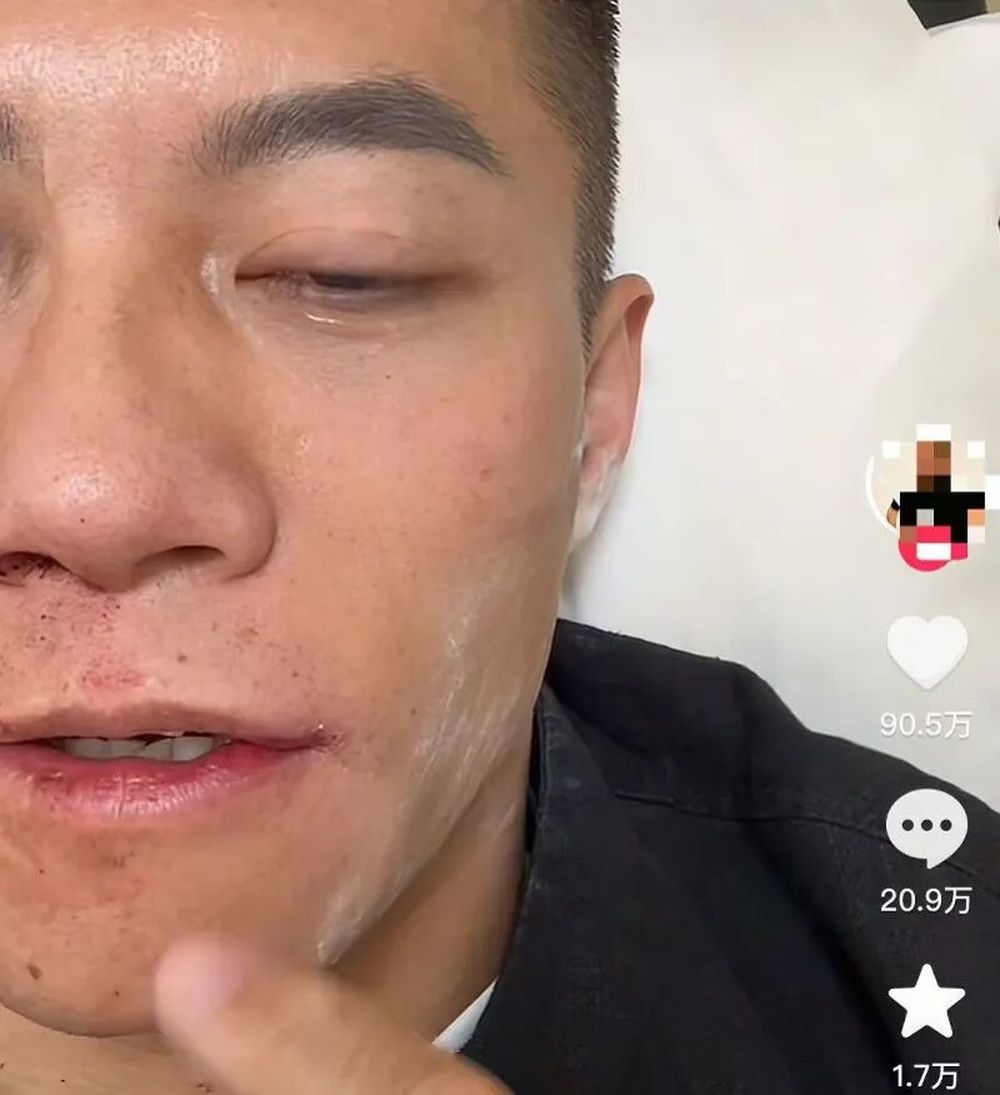 赵鸿刚出战世界扇耳光大赛被KO, 本人回应: 没有脑震荡, 眼眶缝了5针