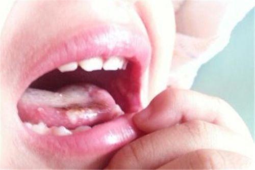 鹅口疮舌头症状图片图片