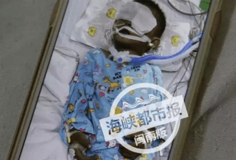 氰化物中毒,男孩身体缺氧发黑