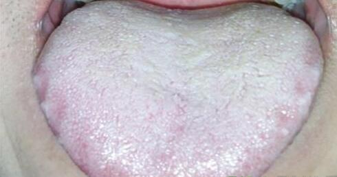 下半身肥胖, 舌苔厚,白腻, 没精打采, 每天吃它, 湿气去无踪