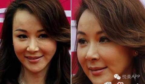 萧蔷,目测应该是右下颌角凹陷缺失,导致脸歪