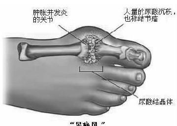 得了尿酸高, 你的「肾」还好吗