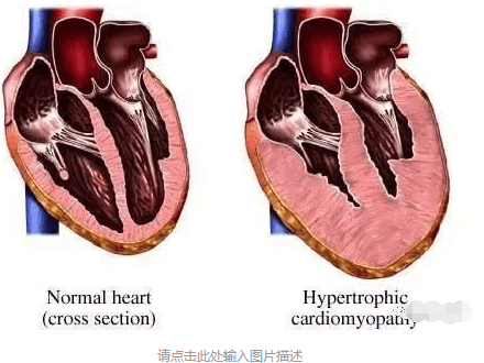 什么是心肌梗死? 为家人看看吧