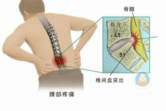 腰椎間盤突出常發生在哪個節段, 收藏起來吧