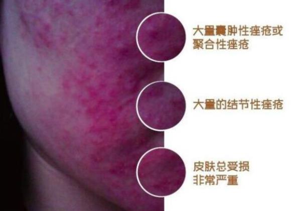重度激素依赖性皮炎怎么治疗