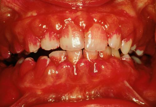 牙龈出血么每天出血, 肿胀真的是上火所致吗?