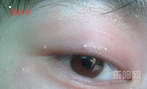 闭口粉刺和脂肪粒区别