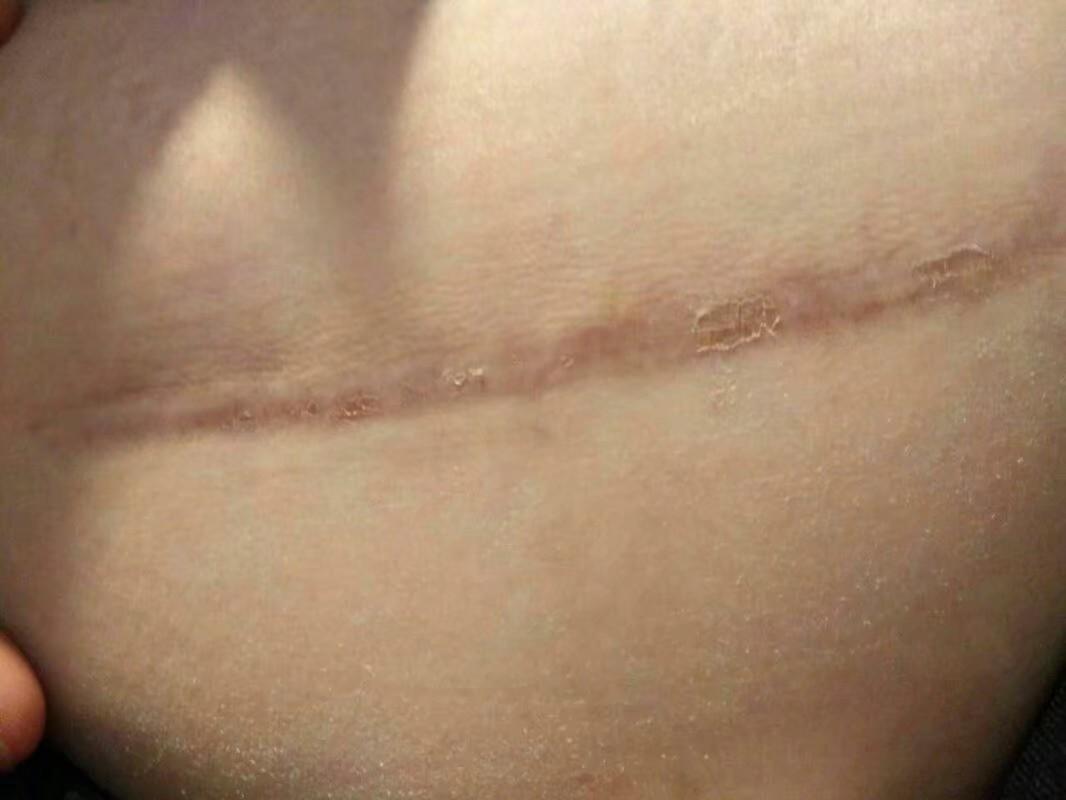 剖腹产三个月疤痕图片图片