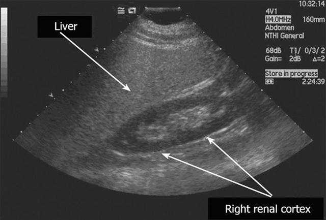 脂肪肝——脂肪肝如何确诊?