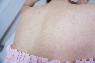 后背长的小米粒是什么? 很影响美观, 挤出来