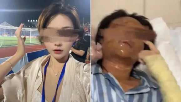 女主播被伪装包裹烧伤 当事人发声
