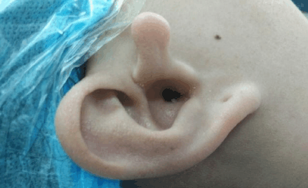 耳朵肉芽图片