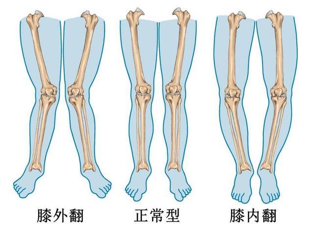 孩子扁平足,o型腿,x型腿? 可能都是媽媽選錯了鞋!