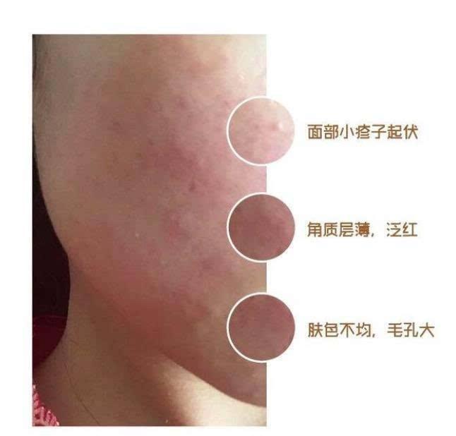 重度激素依赖性皮炎怎么治疗