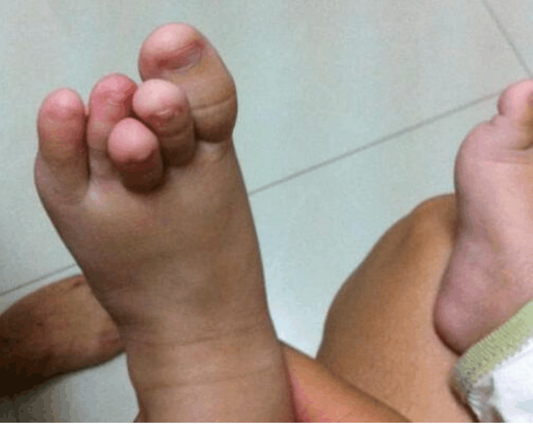 宝宝满月后, 脚趾很不对劲, 医生说一周岁后进行矫正
