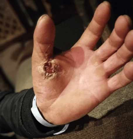 就是因为伤者陈某当时触电也许是其个体差异,被电击瞬间电流从身体