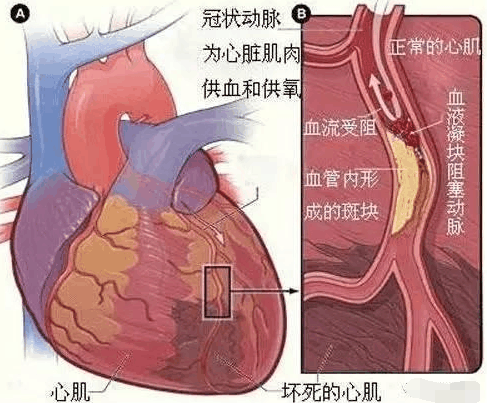 什么是心肌梗死? 为家人看看吧